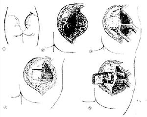 骶髂关节结核 骶髂关节结核