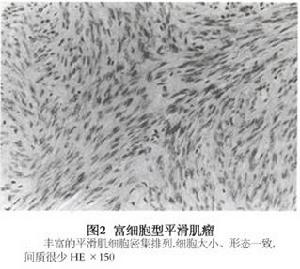 富细胞型平滑肌瘤