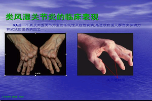 类风湿性关节炎