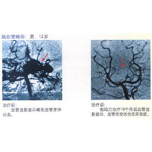 脑血管畸形
