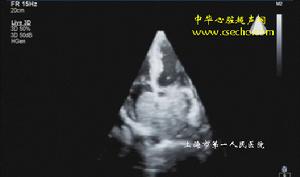心脏粘液瘤 心脏粘液瘤