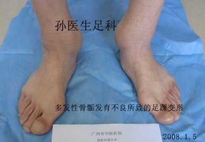 多发性骨骺发育不良 多发性骨骺发育不良