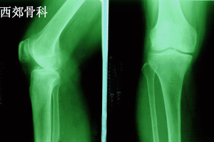 类风湿性关节炎
