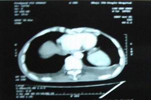 甲状旁腺功能减退症