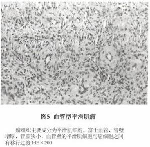 血管型平滑肌瘤