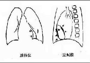 慢性缩窄性心包炎 慢性缩窄性心包炎
