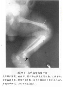 多发性骨骺发育不良 多发性骨骺发育不良