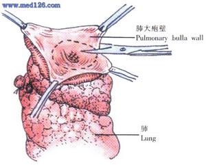 肺大疱