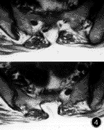 脂肪栓塞综合征