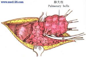 肺大疱