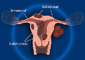 子宫肌瘤