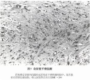 奇异型平滑肌瘤或称非典型平滑肌瘤