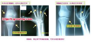 多发性骨骺发育不良 多发性骨骺发育不良