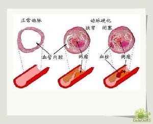 妊娠糖尿病 妊娠糖尿病