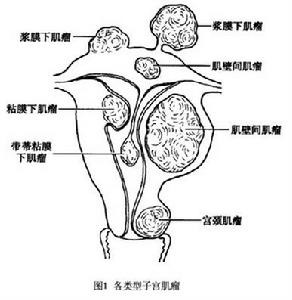 子宫肌瘤