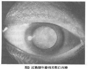 年龄相关性白内障 年龄相关性白内障