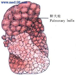 肺大疱