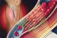 食管贲门失弛缓症