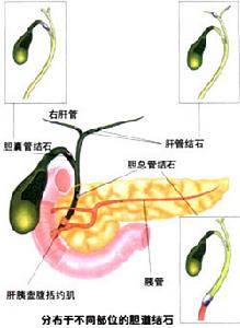 急性胆囊炎
