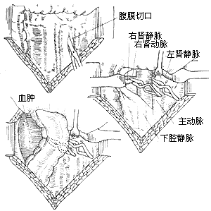 肾损伤 肾损伤