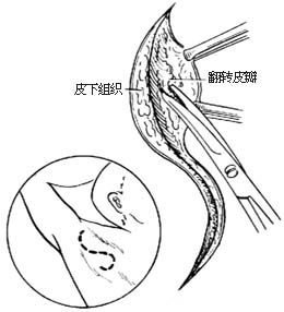 臭汗症 臭汗症