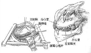 慢性缩窄性心包炎 慢性缩窄性心包炎