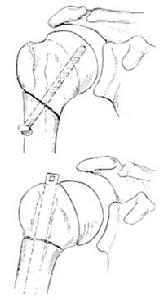 肱骨外科颈骨折