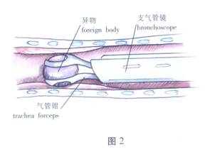 气管、支气管异物