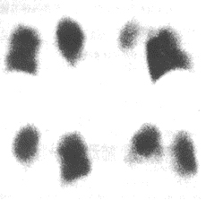 脂肪栓塞综合征
