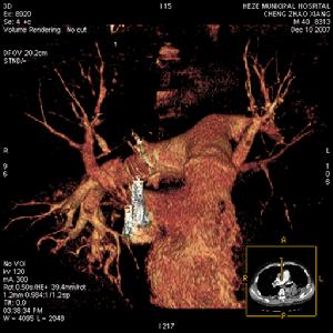 脂肪栓塞综合征