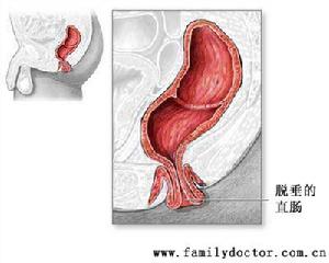 直肠脱垂