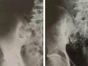 骶髂关节结核 骶髂关节结核