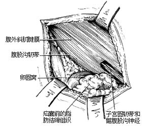 腹股沟斜疝 腹股沟斜疝