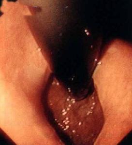 食管贲门失弛缓症