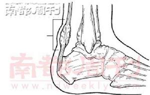 跟腱前囊炎 跟腱前囊炎