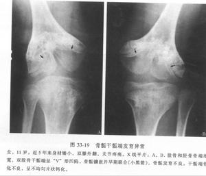 多发性骨骺发育不良 多发性骨骺发育不良
