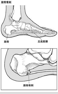 跟骨骨刺综合征 跟骨骨刺综合征