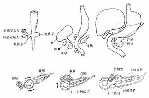 先天性十二指肠闭锁 先天性十二指肠闭锁