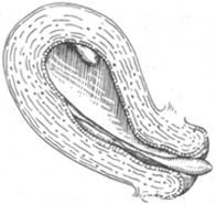 （图）子宫内膜息肉