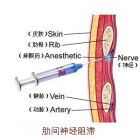 肋骨骨折