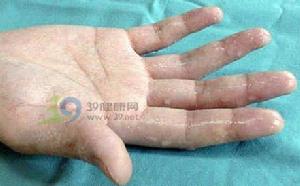 臭汗症 臭汗症