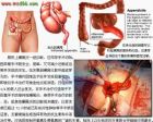 阑尾炎