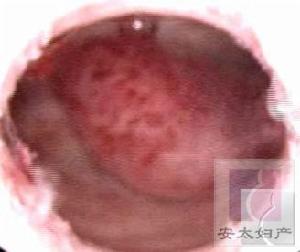 子宫息肉 子宫息肉