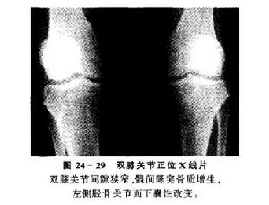 单侧关节突关节脱位 单侧关节突关节脱位