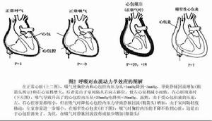 慢性缩窄性心包炎 慢性缩窄性心包炎