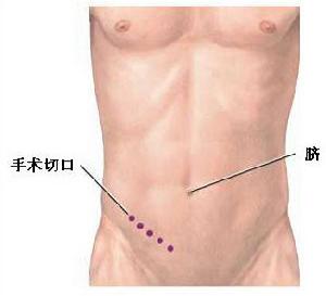 阑尾炎 阑尾炎