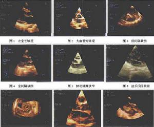 胸主动脉夹层动脉瘤
