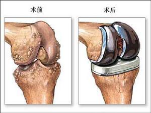 髌骨骨折