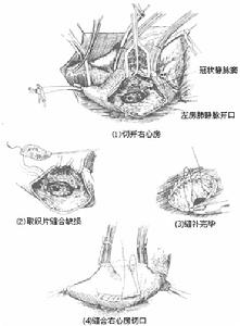 心室间隔缺损