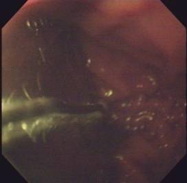 食管贲门失弛缓症